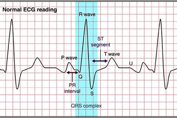 Normal ECG Reading